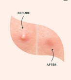 چسب ضد جوش اورژانسی مدل ورقه ای برند سادور 40 عددی